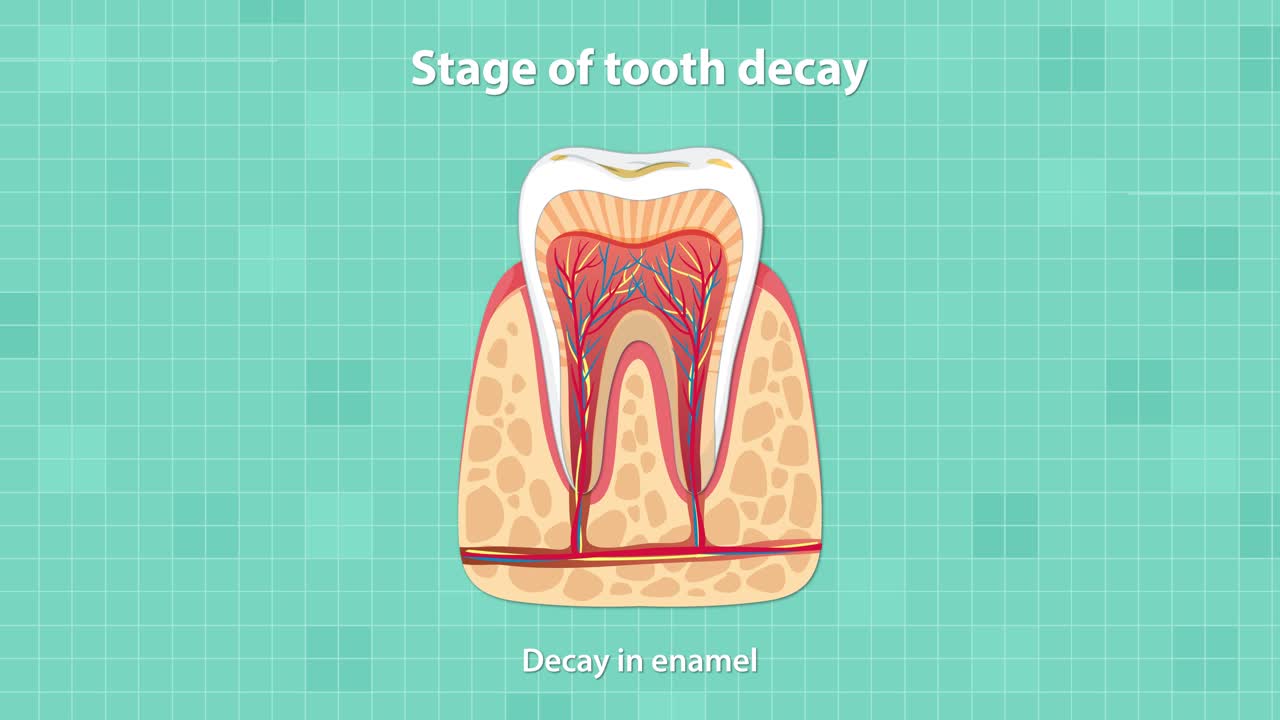 Educational animation illustrates the sequential stages of tooth decay in a cross-sectional tooth diagram, using clear labeling, smooth transitions, and a clinical, teal background