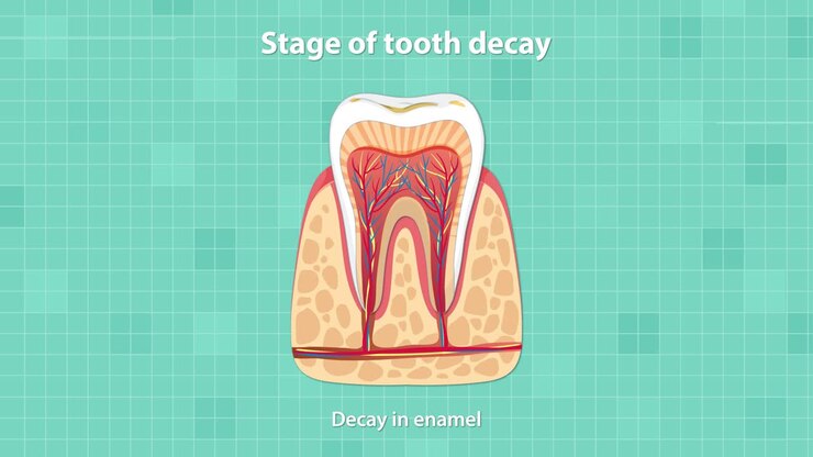 Educational animation illustrates the sequential stages of tooth decay in a cross-sectional tooth diagram, using clear labeling, smooth transitions, and a clinical, teal background