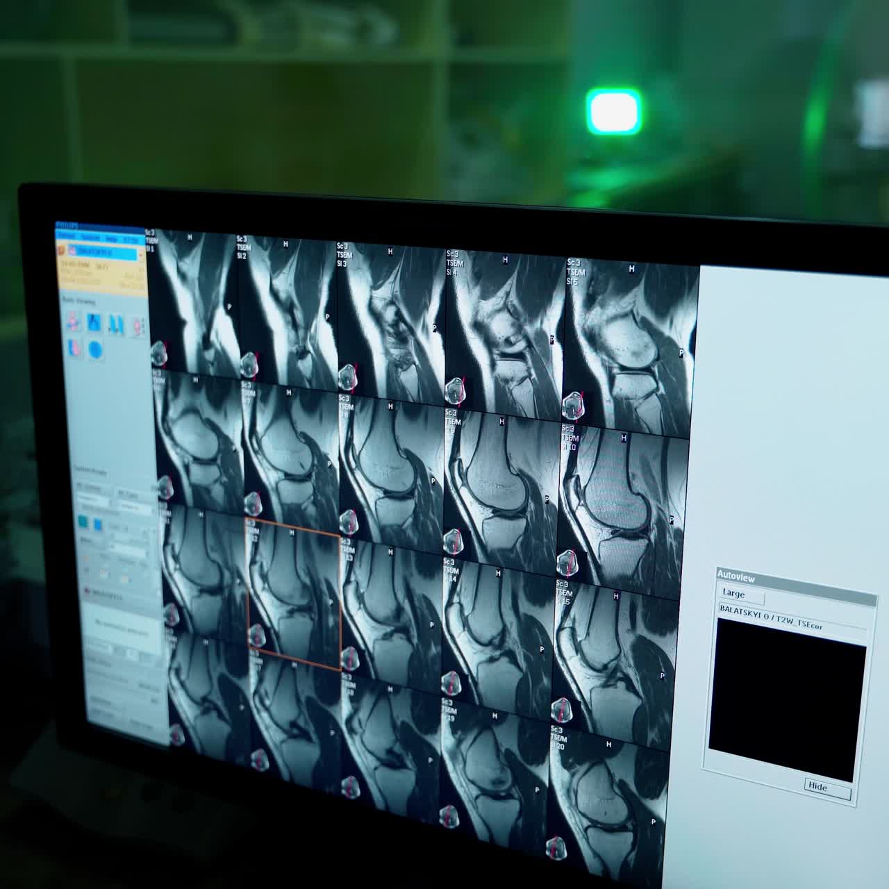 Radiology x-ray on computer display. Monitor is showing the scan results of patient. X-ray medical cabinet in hospital. Workplace of doctor in clinic. Healthcare.