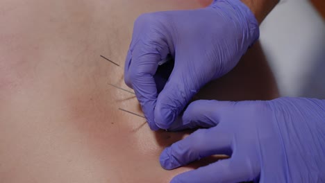 close up of gloved hands placing acupuncture needles in a line along the back during treatment