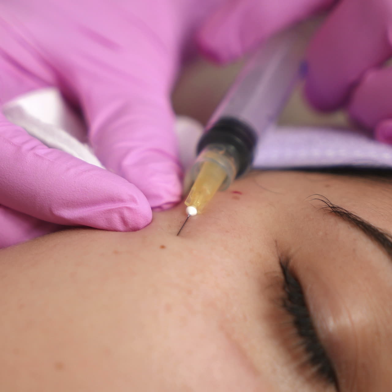 procedimiento de inyección facial