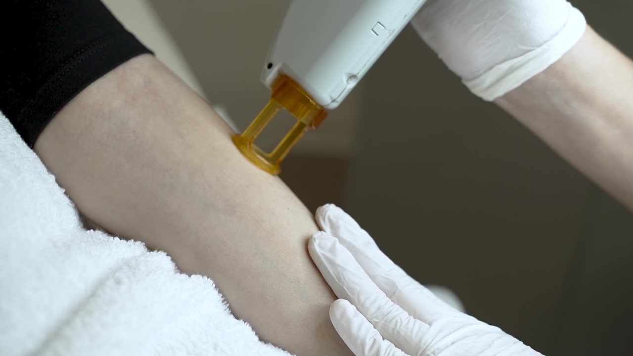 mujer recibiendo tratamiento de depilación láser apotrixosi en su brazo - de cerca