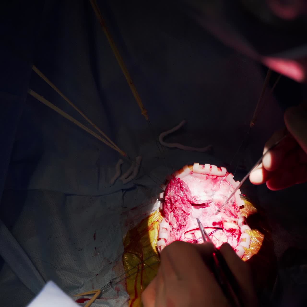 Internal organ of a patient during neurosurgery. Doctors hands use surgical tools at surgery on dark background. Light spot on surgical process. Close-up.Top view.