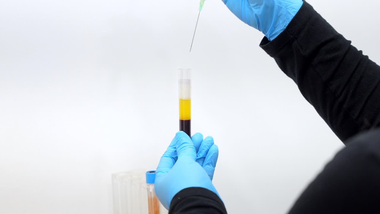 Medical procedure with blood sample and syringe in laboratory