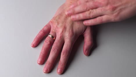 mujer con piel roja, seca y con picazón aplicar crema para las manos en el punto alérgico de la psoriasis
