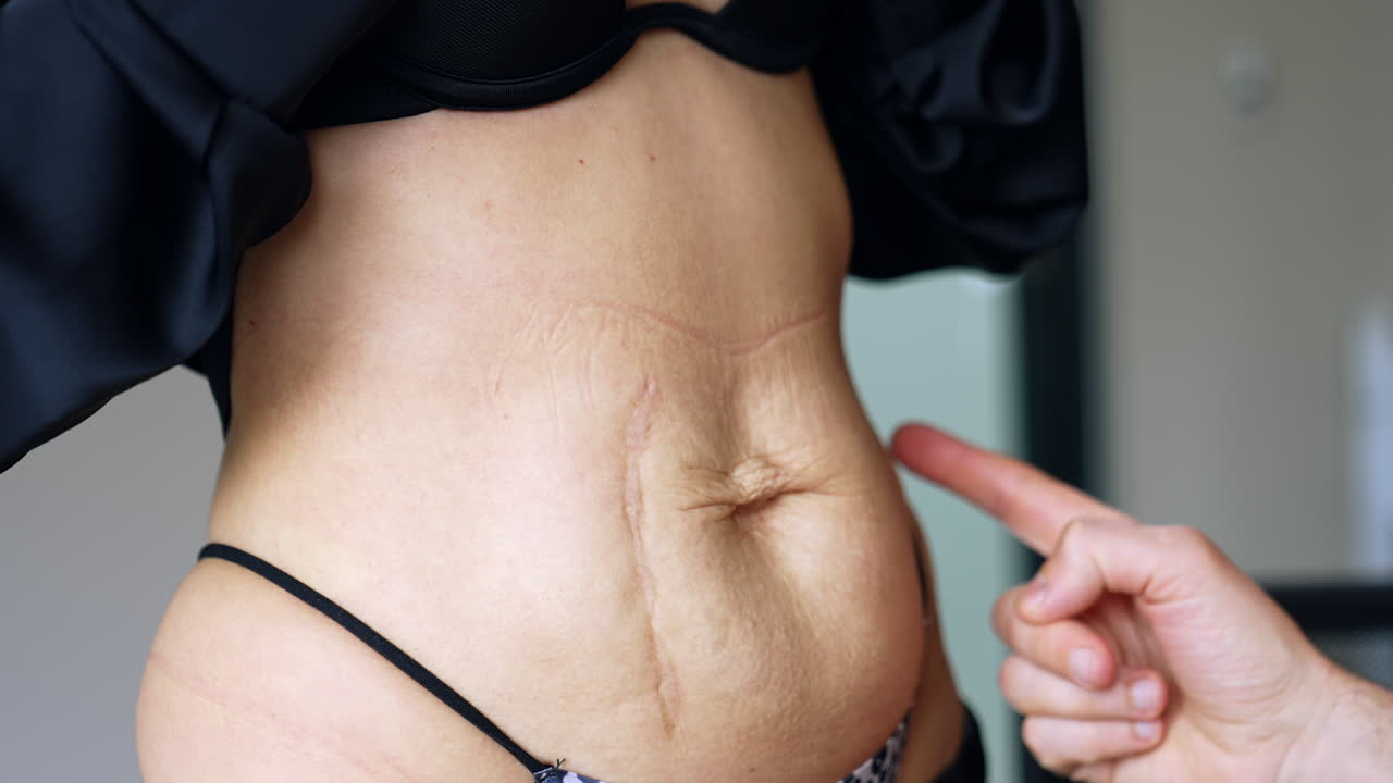 Male hands touch the female belly with loose wrinkled skin. Plastic surgery preparation and consultation. Close up.