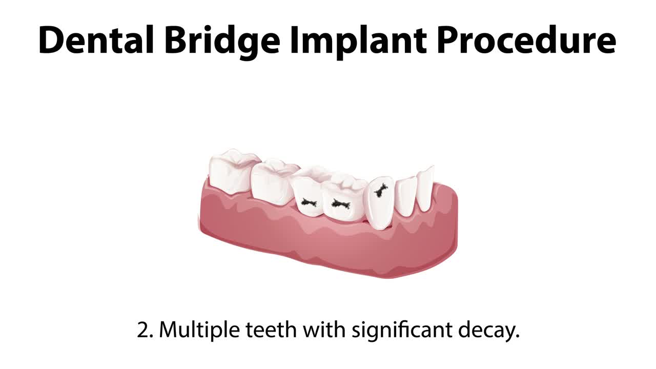 단계별 치과 브릿지 임플란트 절차를 시각화합니다.