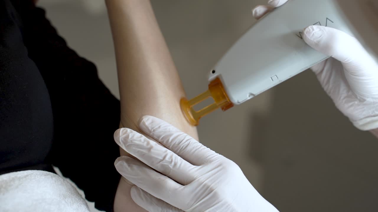 procedimiento de apotrixosi en el brazo femenino - de cerca