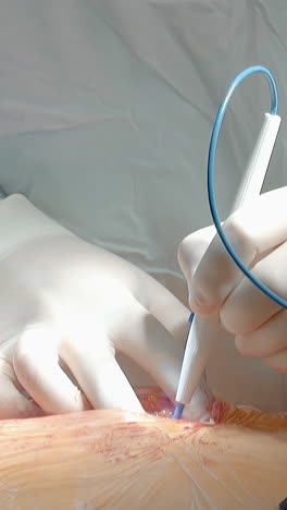 el médico realiza una cirugía en un primer plano del corazón. el cirujano de cardiología con bisturí láser durante la cirugía de bypass de la arteria coronaria en la clínica. procedimiento urgente