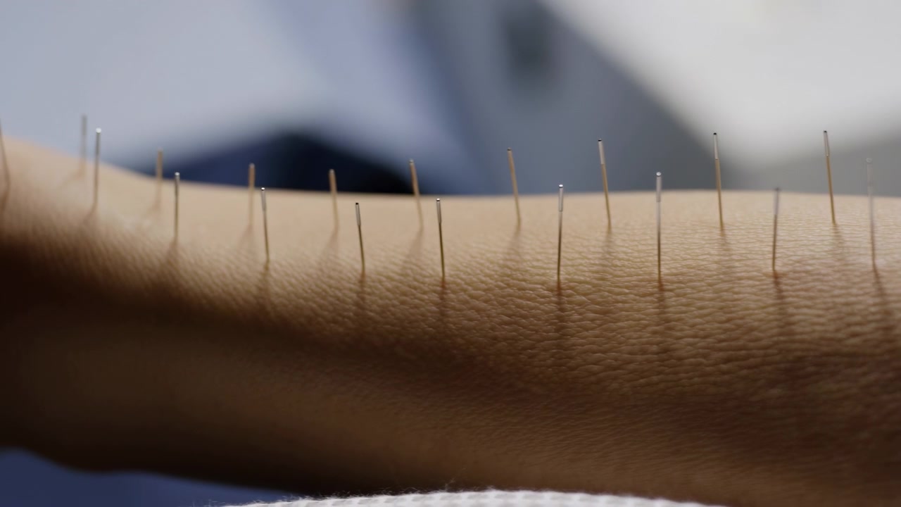 Molti sottili aghi da agopuntura in acciaio inossidabile sono eretti lungo la pelle dell'avambraccio umano sotto una morbida illuminazione clinica, con sottili rientranze nei punti di ingresso, una texture superficiale fine e un ambiente medico asettico.