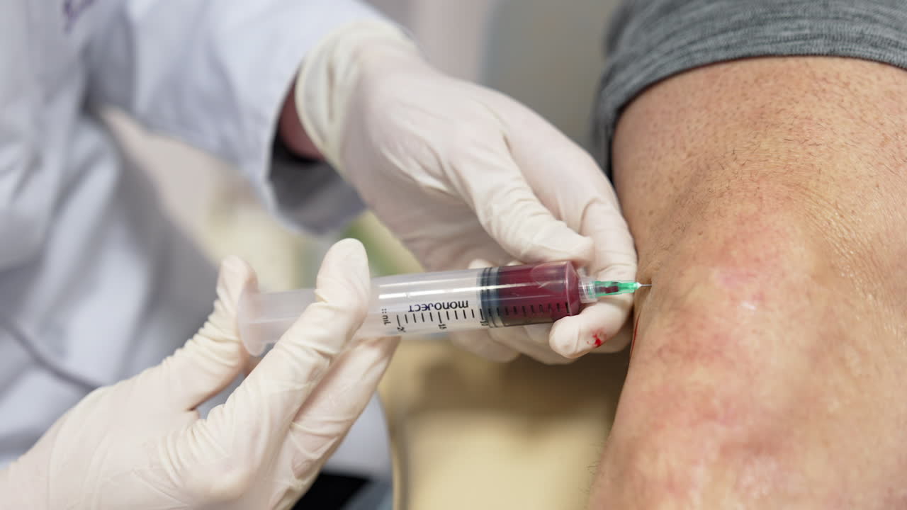 Plasma is input into patient's knee. Close up. Orthopedics and traumatology cured by PRP therapy.