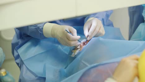 laser vision correction. a patient and team of surgeons in the operating room during ophthalmic surgery