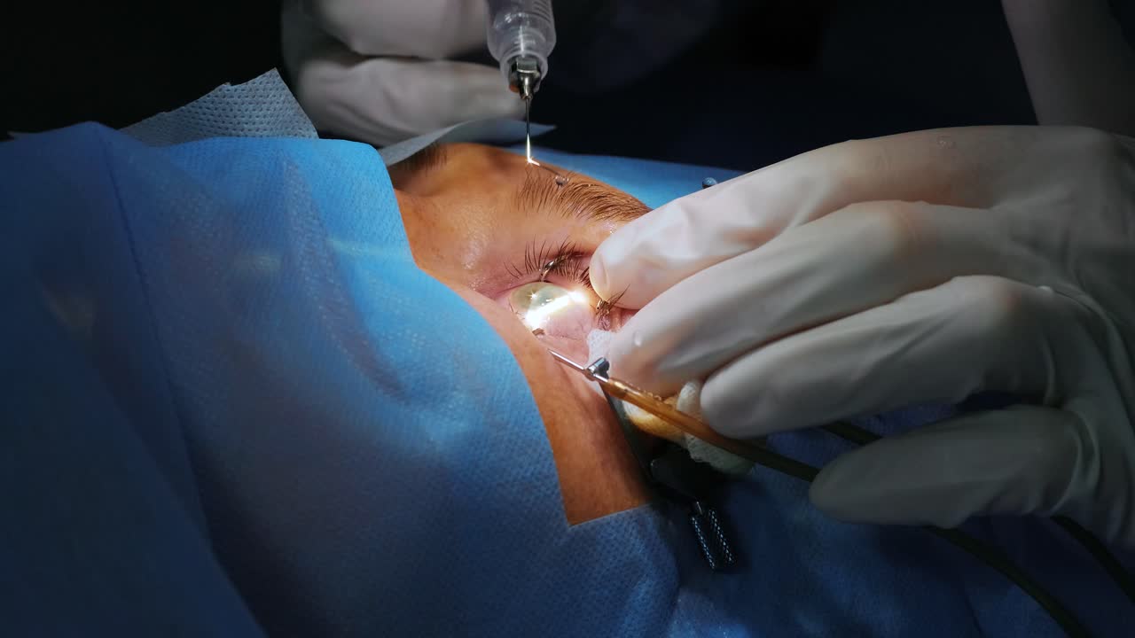 corrección de la visión con láser. un paciente y un equipo de cirujanos en la sala de operaciones durante una cirugía oftalmológica. especulo del párpado. tratamiento de lasik. paciente bajo una cubierta estéril