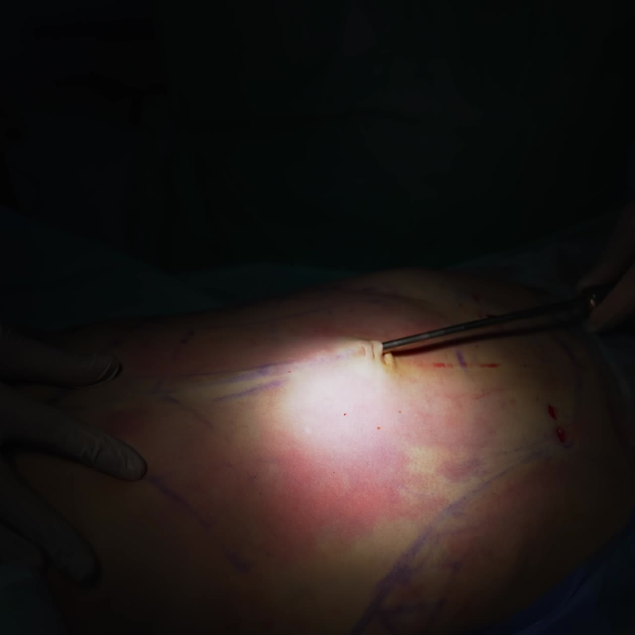 Surgical procedure on patient's belly. Surgical instrument removing fat. Liposuction on black background. Light spot with operation. Close-up