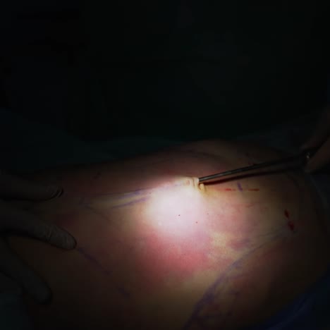Surgical procedure on patient&#039;s belly. Surgical instrument removing fat. Liposuction on black background. Light spot with operation. Close-up