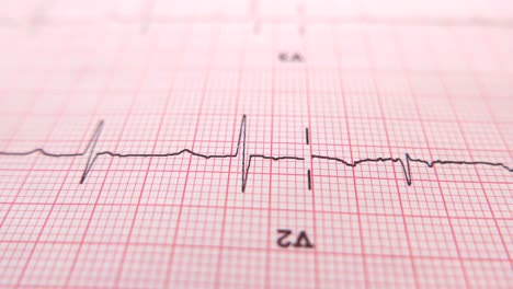 seguimiento del electrocardiograma (ecg)