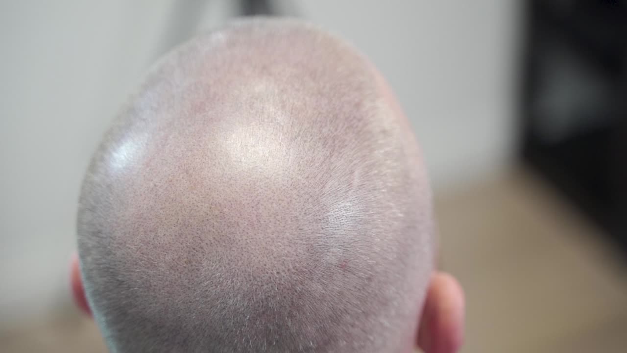 미세 색소 침착 치료중인 남자