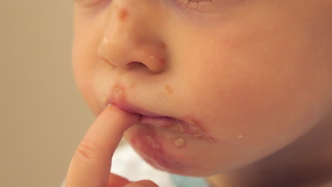 baby scratching his chin with impetigo - bacterial skin infection