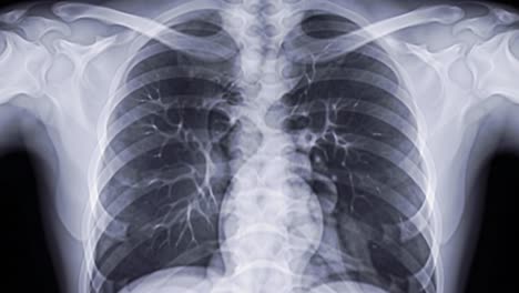a detailed examination of chest x-ray images highlighting lung structures, heart positioning, and potential abnormalities. provides insights into common health issues visible through x-rays.
