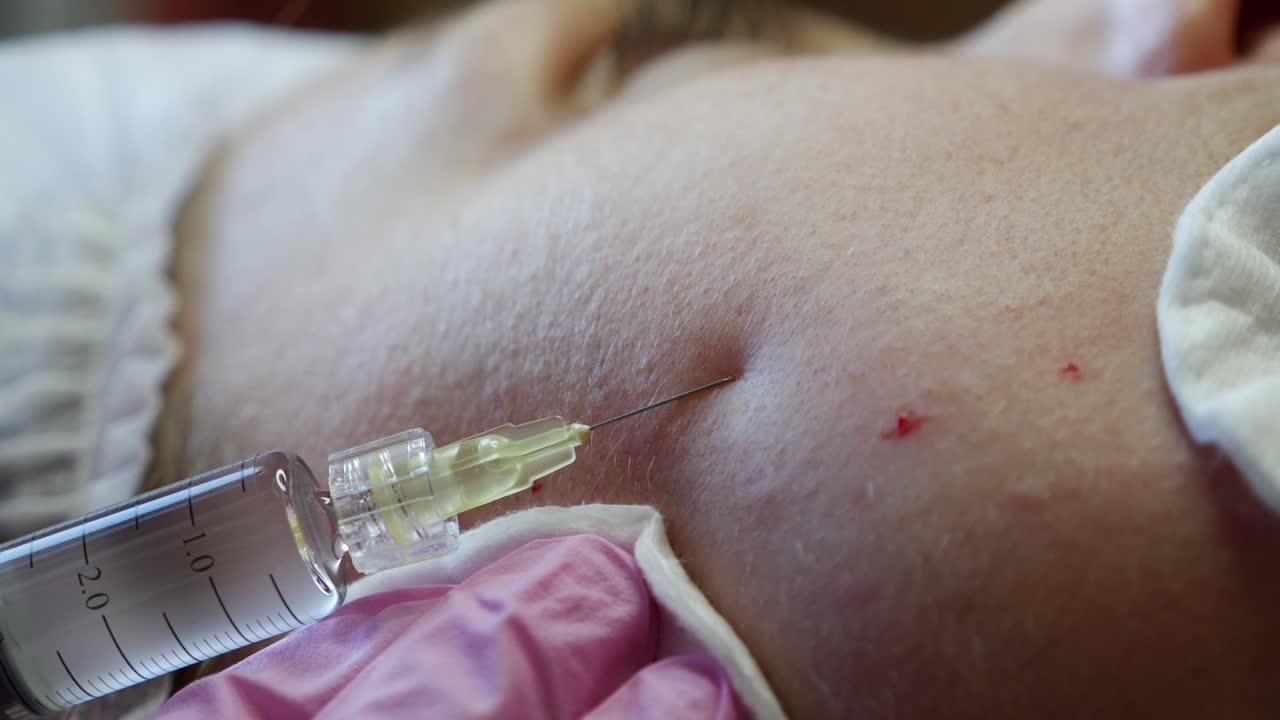 procedimiento de inyección cosmética