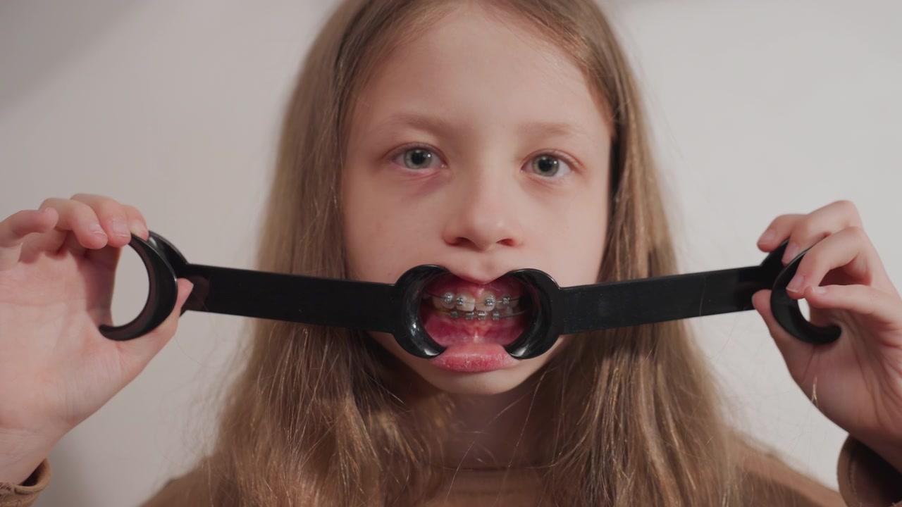 Gros plan d'une jeune fille aux longs cheveux bruns portant un appareil dentaire maintenu ouvert par un écarteur orthodontique. L'attention reste sur sa bouche et son appareil dentaire tout du long, mettant en évidence des dents détaillées.