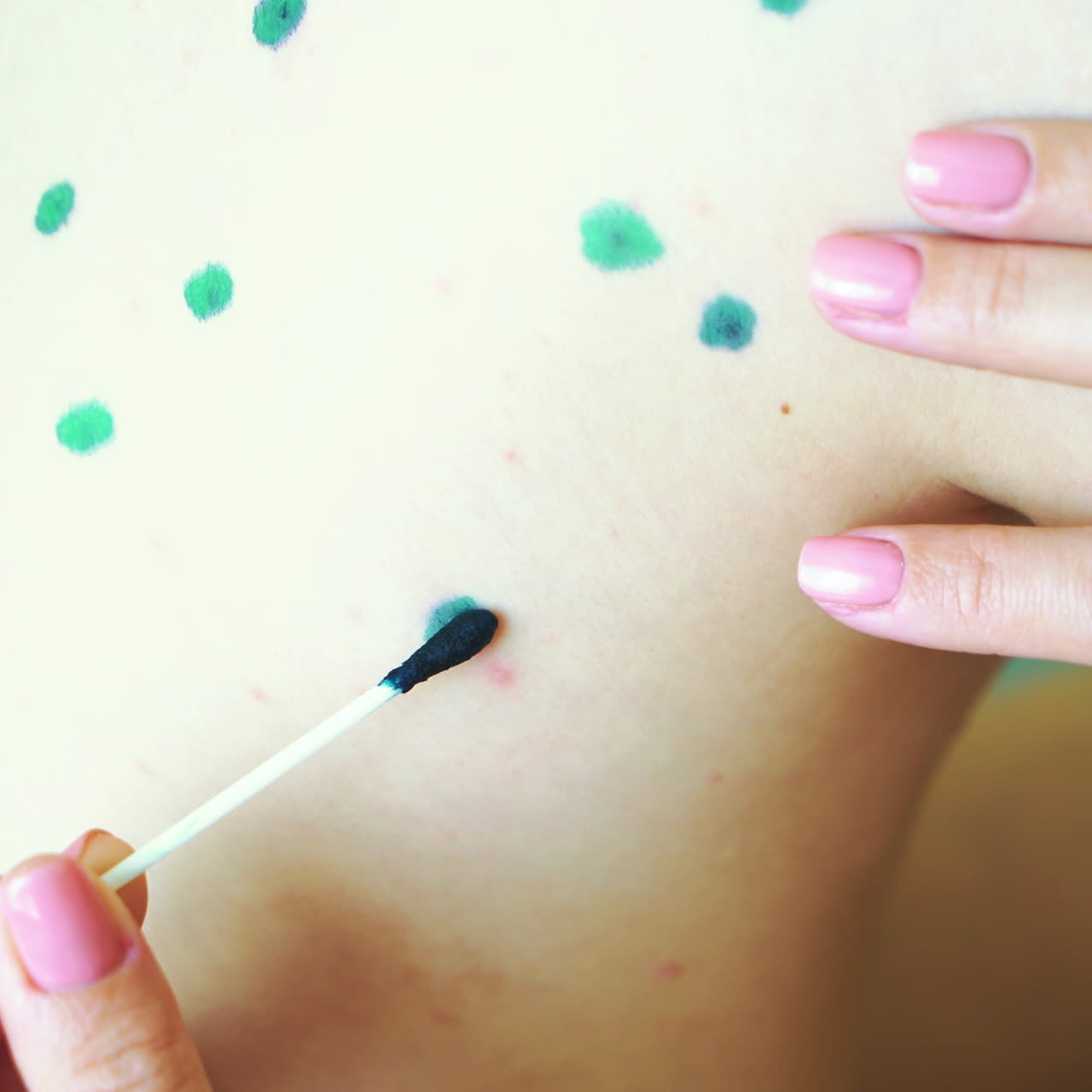 Little boy with chickenpox. Mother applying antiseptic solution to rash. Home treatment. Square video