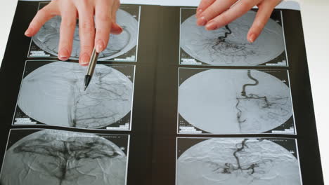 medical professional examining brain angiography x-ray films