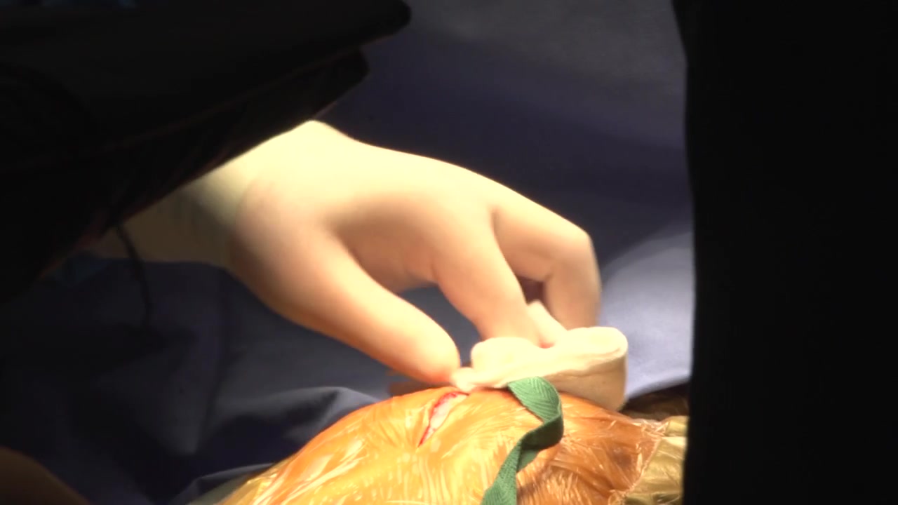 Extreme close-up shot of a surgeon in sterile gloves carefully operating on a patient, utilizing specialized medical tools under bright theatrical lighting during a hospital surgical procedure.
