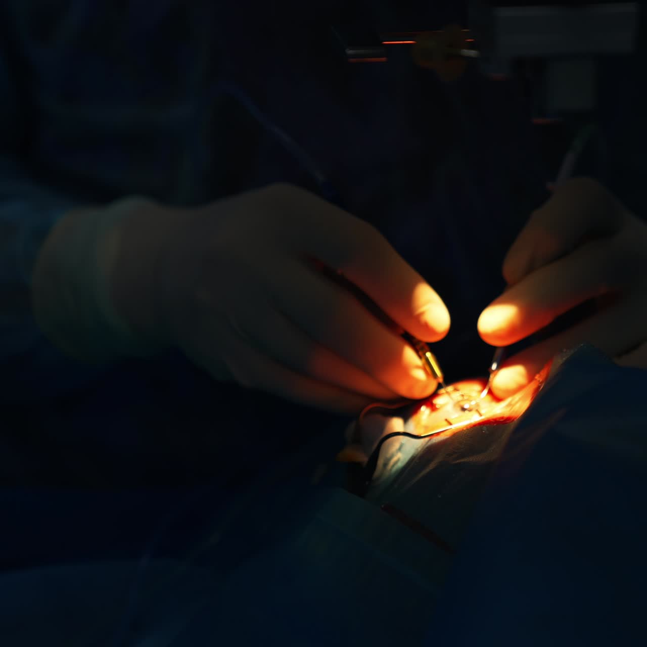 Highlighted operated area in dark surgery room. Doctor applying tools doing delicate eye surgery. Close up