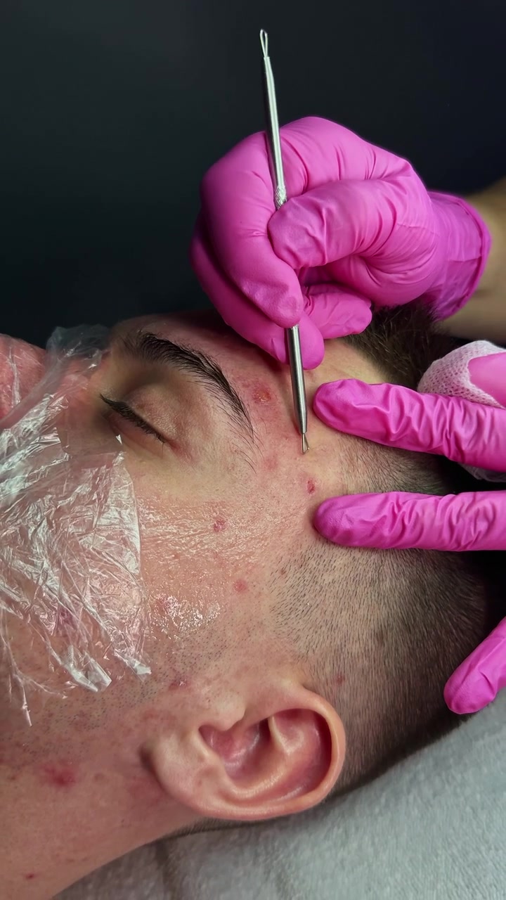 Sessione di trattamento della pelle per la rimozione di acne e imperfezioni in una clinica estetica nel pomeriggio con mani e strumenti attenti su un paziente.