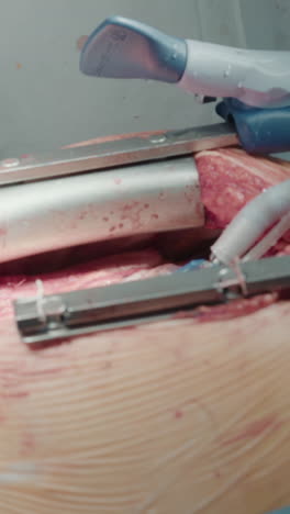 dispositivo estabilizador del corazón en el pecho. el cirujano utiliza equipos para mantener el corazón quieto mientras se realiza una cirugía de bypass. proceso de injerto de bypass de la arteria coronaria