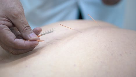 acupuncture treatment session