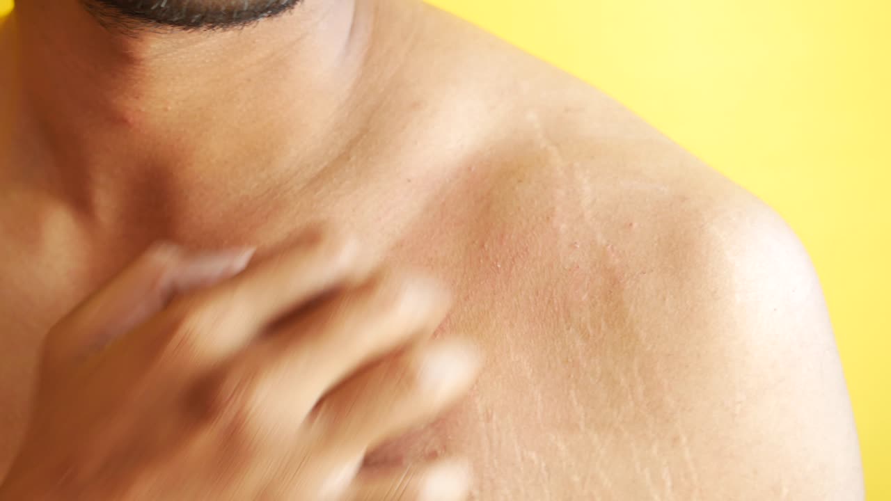 肩をかき傷つける 肩の発疹