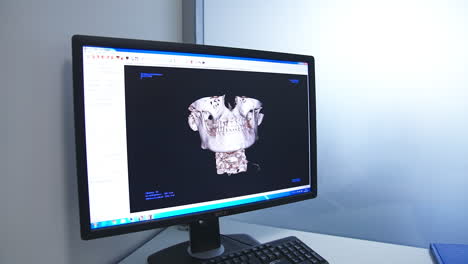 dental 3d scan on computer monitor