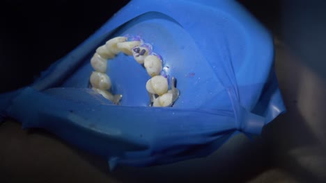 un dentista experto con guantes pulida la prótesis con un micro motor
