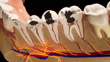 molar teeth damaged by caries. medically accurate tooth 3d animation