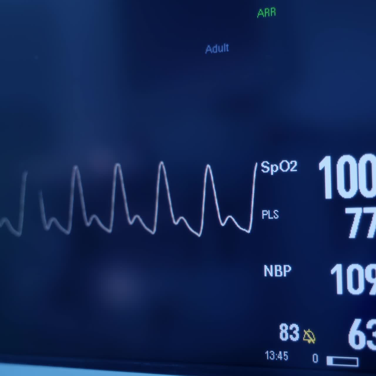 Monitor della frequenza cardiaca. Schermo del monitor che registra le letture del polso. Il monitor visualizza i segni vitali di un paziente. Esame medico. Monitoraggio cardiaco. Elettrocardiografia