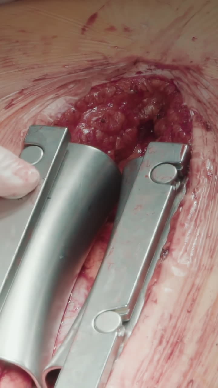 el médico opera utilizando un dilatador quirúrgico. el cirujano utiliza meticulosamente una herramienta médica para realizar un bypass de la arteria coronaria, asegurando un procedimiento médico suave y seguro