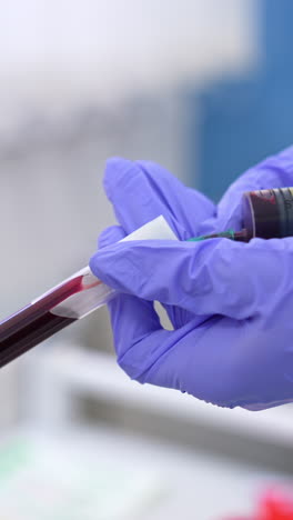 female nurse's hands in protective latex glove fill the test tube with blood from a syringe. close up. blood test analysis in laboratory. vertical video