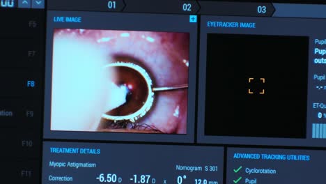 ophthalmic surgery. view on the screen of medical monitor in operating room. lasik