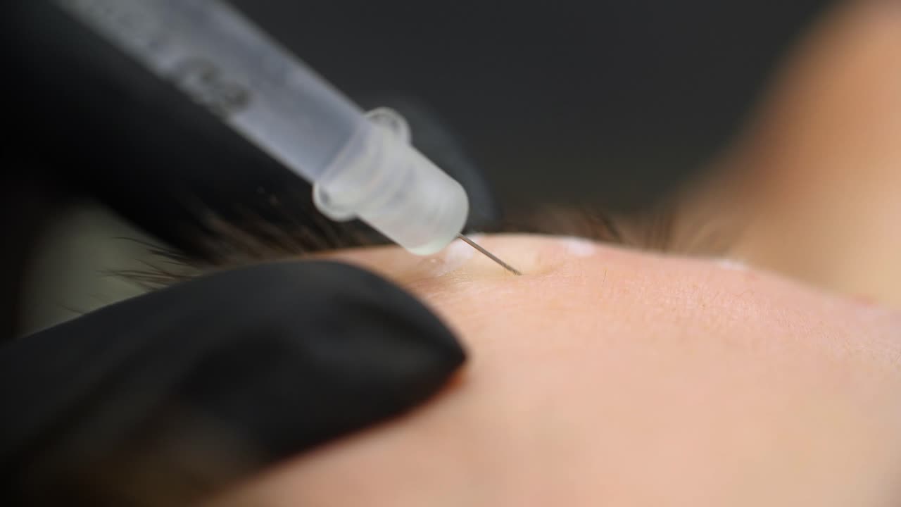 Botox injection by beautician with a syringe into a woman's forehead. Close up.