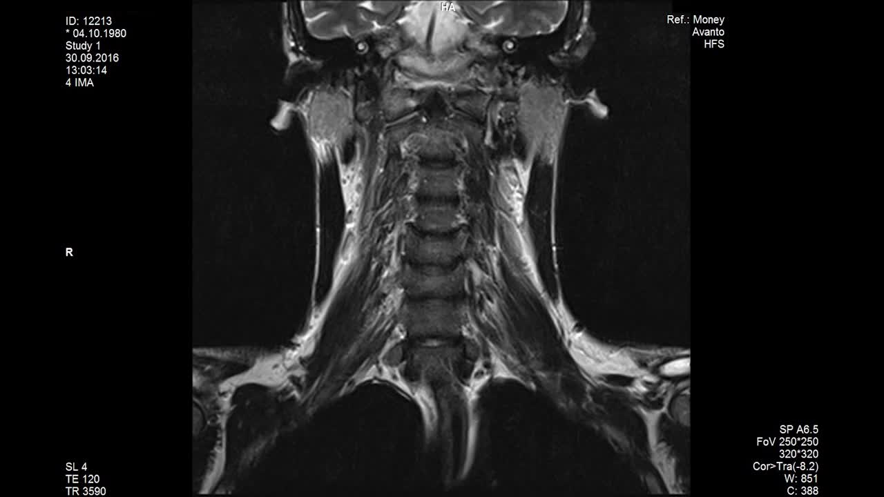 MRI scans the lumbar spine