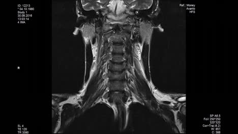 mri scans the lumbar spine