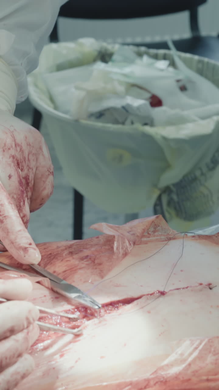 Surgeon closes skin after surgery. Attentive doctor carefully uses tools making sutures on chest after coronary artery bypass surgery in hospital