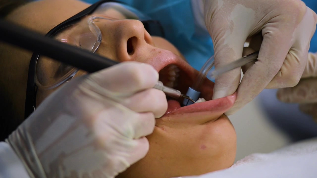 Dentista che usa un trapano dentale per pulire i denti sporchi