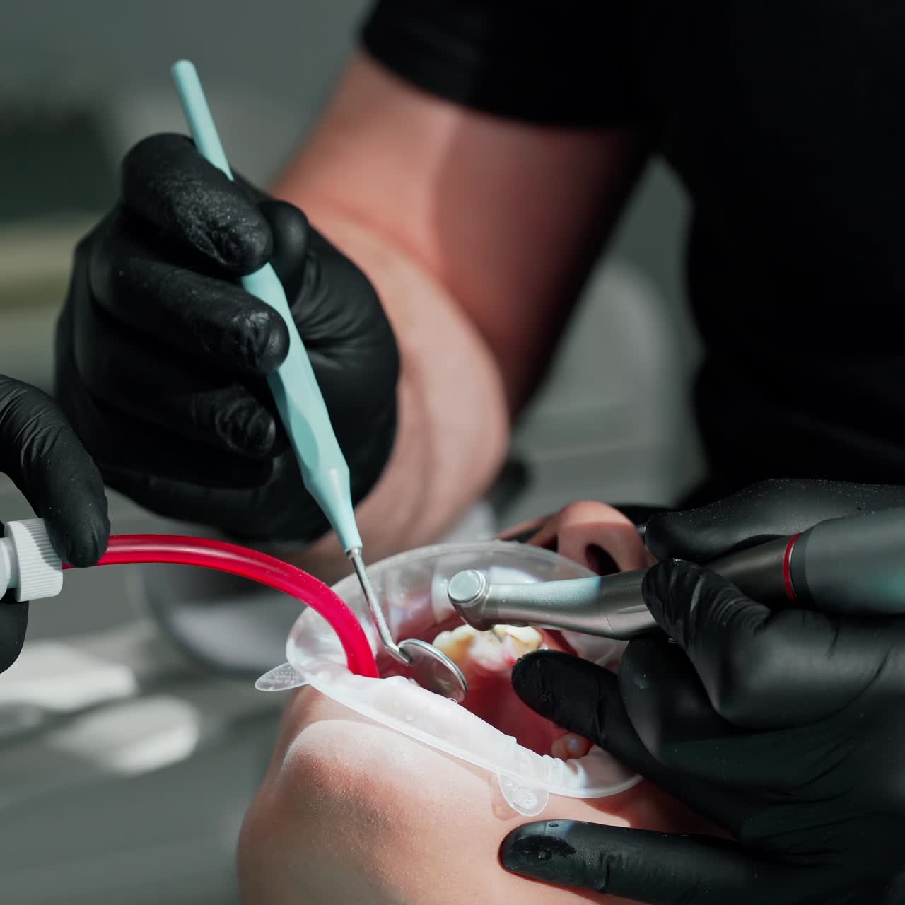 Female patient's face with open mouth. Hands of dentist in gloves with medical tools treating client's teeth. Patient receiving tooth treatment in dental office. Close-up.