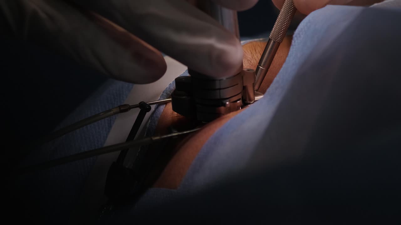 레이저 시력 교정: 안과 수술 중에 수술실에 있는 환자와 수술팀; 눈꺼풀 스럼; 라식 치료; 불임 개 아래의 환자