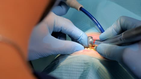 el especialista dental prepara los dientes del paciente para carpetas cerámicas con herramientas especiales. conceptos de personas, medicina, estomatología y atención médica