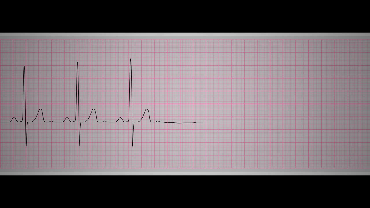 синусовая аритмия