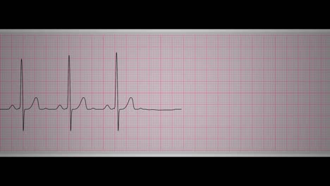 ecg (시누스 부정맥)